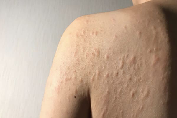 Urticaria