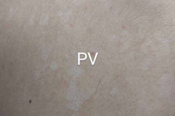 Tinea Versicolor