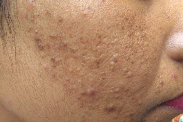 Tinea Versicolor