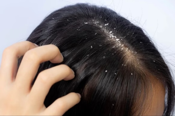 Dandruff